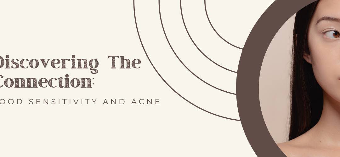 Discovering The Connection: Food Sensitivity And Acne